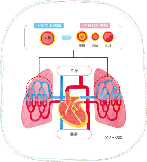 Pahの病態 Pah 肺動脈性肺高血圧症 患者さんのための情報サイト Produce A Hope